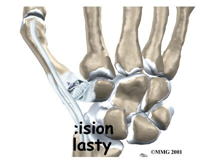 Resection Arthroplasty of the Thumb	