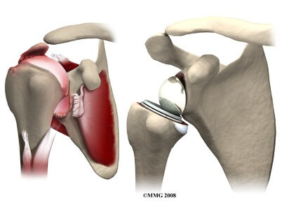 Reverse Shoulder Arthroplasty	