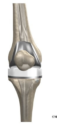 Revision Arthroplasty	