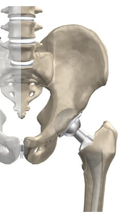 Revision Arthroplasty	