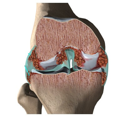 Rheumatoid Arthritis	