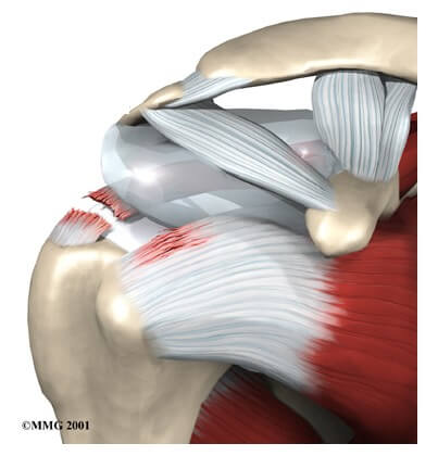 Rotator Cuff Tears