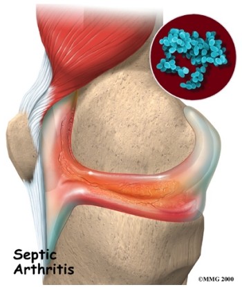 Septic Arthritis	