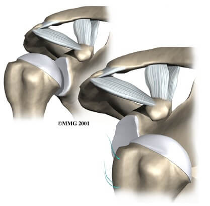 Shoulder Instability	