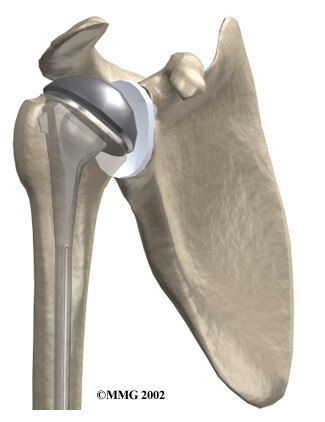 Artificial Joint Replacement	