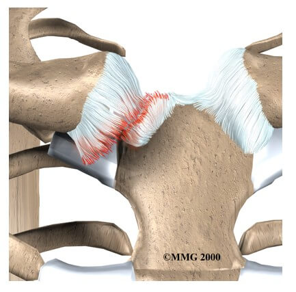 Sternoclavicular Joint Problems	