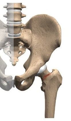 Stress Fracture of the Hip	