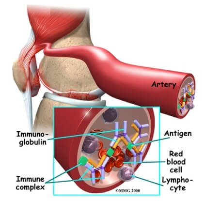 Systemic Lupus Erythematosus	