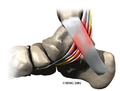 Tarsal Tunnel Syndrome	