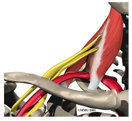 Thoracic Outlet Syndrome	