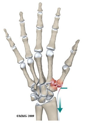 Thumb Metacarpal Fractures	