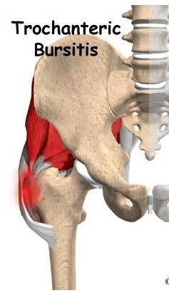 Trochanteric Bursitis	