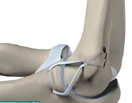 Ulnar Collateral Ligament Reconstruction	