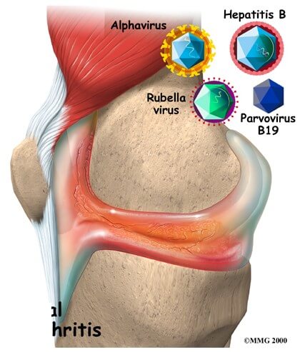 Viral Arthritis	