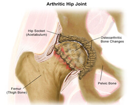 arthritic hip joint