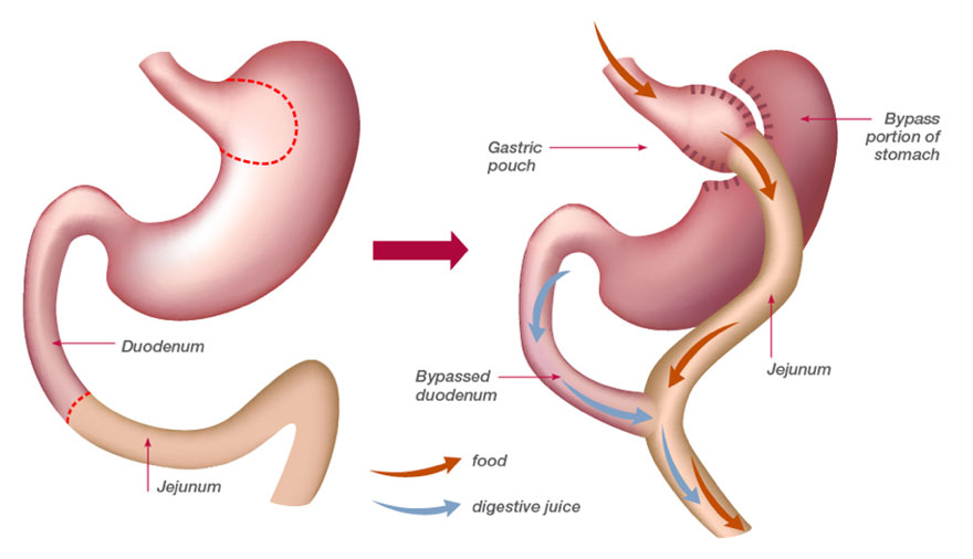 Bariatric-Roux-en-y Gastric Bypass
